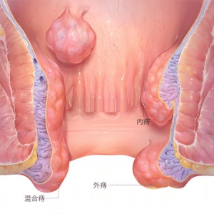 如果得了痔瘡不動手術有什么好辦法 誰有經驗